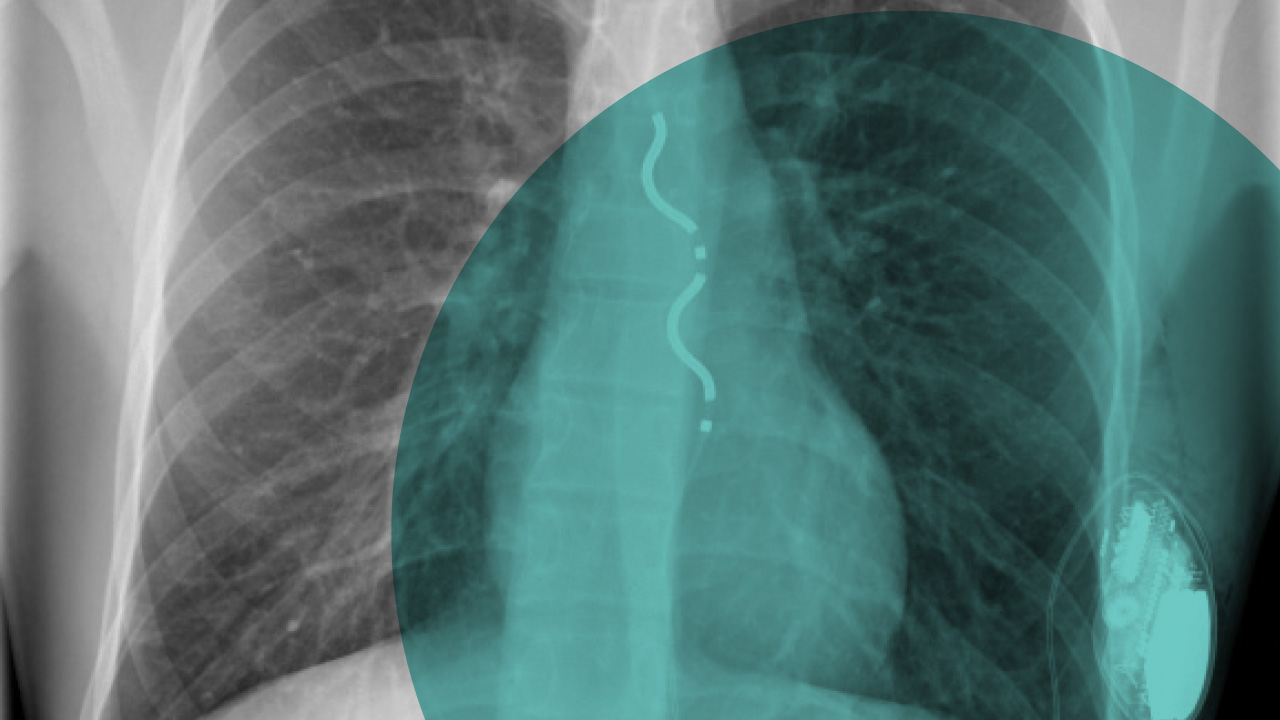 An X-ray of the chest showing the ribs and and the EV-ICD device implanted with a teal circle placed over the top to highlight the device.
