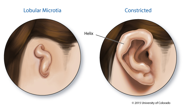 Two circles with a close-up illustration of an ear. In the left one, the ear is bent and it is labeled as lobular microtia. In the right one, labeled Constricted, the ear appears as expected but with a thicker section on the outer ear labeled as Helix.