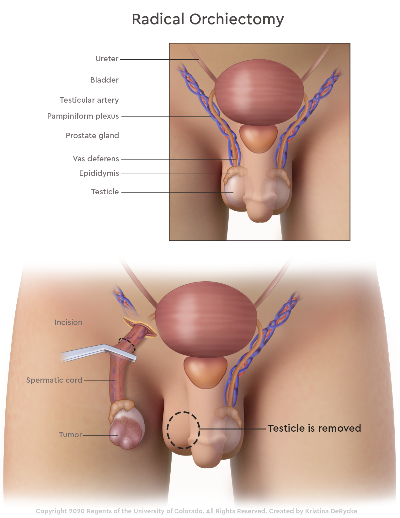 Testicular-Radical-Orchiectomy_v01.png